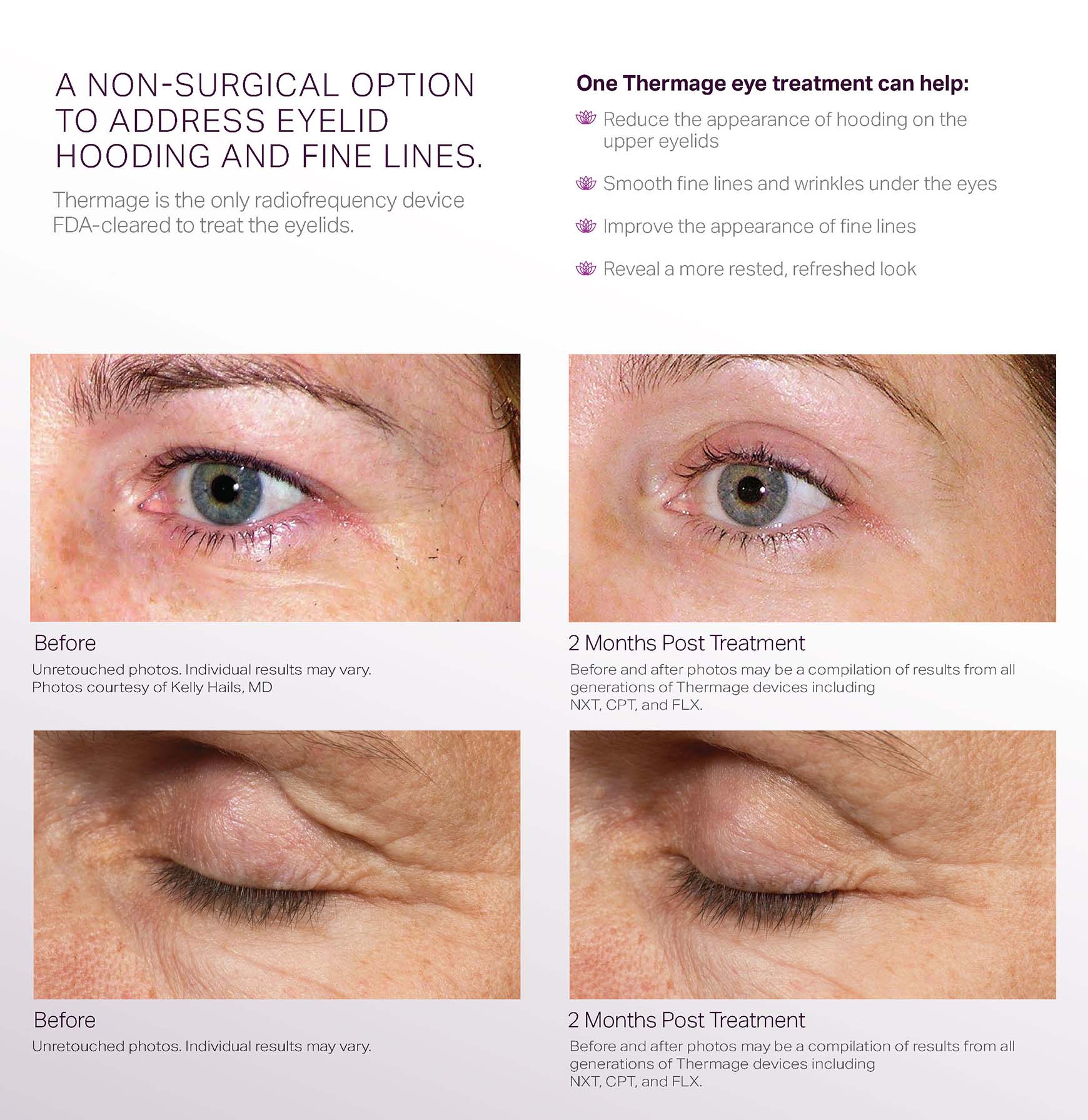 Thermage Collagen Campaign - Consumer Brochure