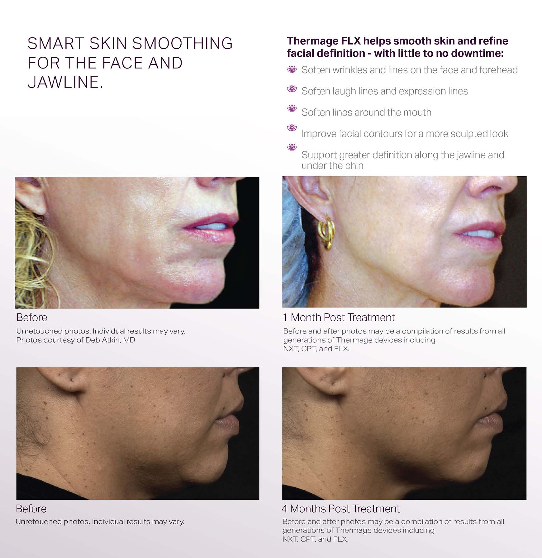 Thermage Collagen Campaign - Consumer Brochure