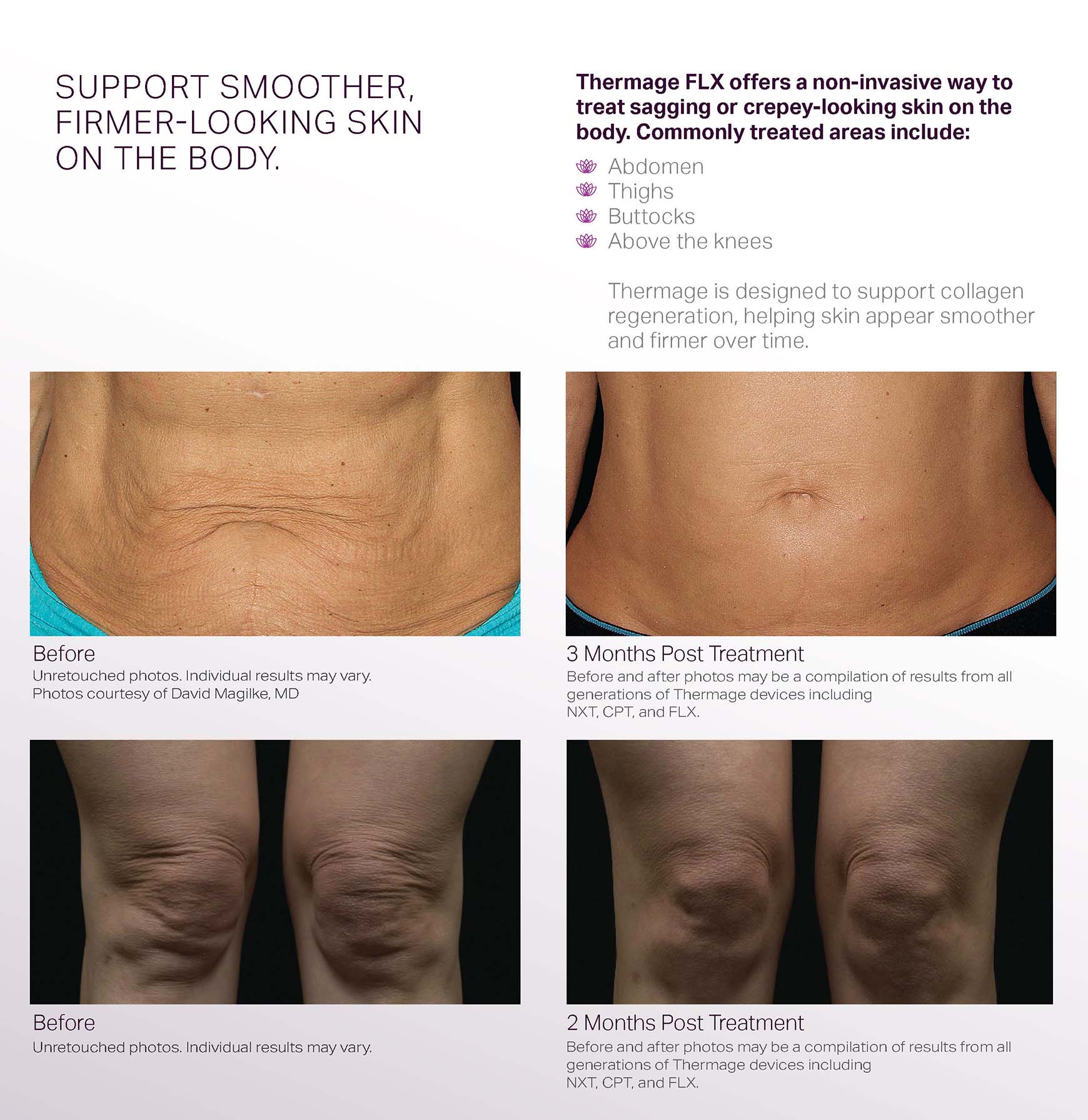 Thermage Collagen Campaign - Consumer Brochure